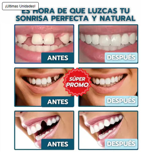 Carillas SmileInstant™: ocultan manchas, espacios y torceduras en minutos, desde casa