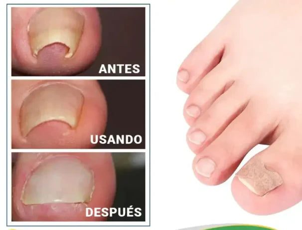 Eliminador de hongos de uñas | 7 days