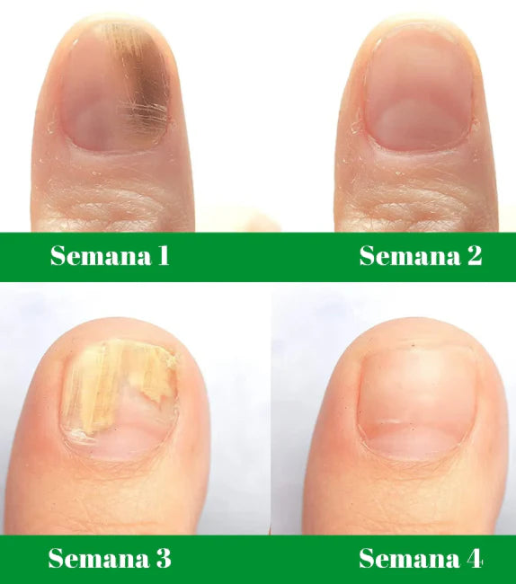 Eliminador de hongos de uñas | 7 days